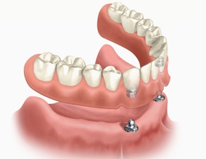 Gebitsprothese op implantaten